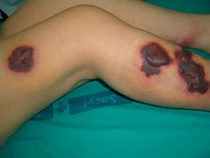 Cutaneous lesions on admission. Bullous erythematous violaceous plaques on the right leg.