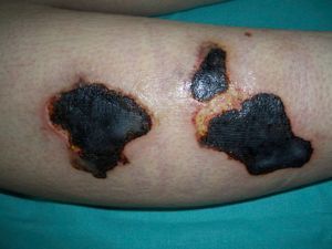 Cutaneous lesions on day 7 of hospitalization. Extensive cutaneous necrosis on the right leg.