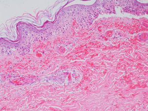 Skin biopsy. Extensive epidermal basal vasculopathy, hemorrhage throughout the dermis with organized thrombi in many dermal vessels and no evidence of vasculitis.