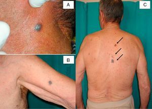 (A) and (B) Oval, blackish, palpable, and painless nodular lesions on the neck and upper limbs. (C) Pigmented skin lesions localized on the spinal column and parascapular region (arrows, from the top to the bottom).