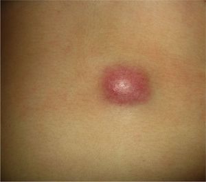 Dermatofibrosarcoma protuberans. Large nodule.
