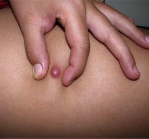 Dermatofibrosarcoma protuberans in an 8-year-old child. Papular, erythematous lesion with a deep nodular component on palpation.