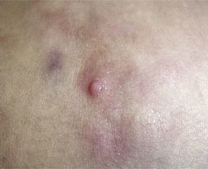 Papular lesion with a bluish base that also reflects involvement of deep structures.