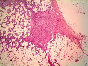 Tumor cells invading adipose tissue, forming islands of adipocytes (hematoxylin-eosin, original magnification ×200).