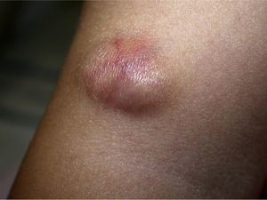 Giant-cell fibroblastoma. Clinically, this lesion is indistinguishable from DFSP.