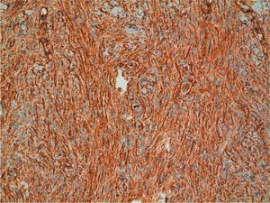 Detail of the cells. Strongly positive CD34 staining (hematoxylin-eosin, original magnification ×200).