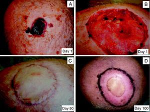 An 81-year-old patient who underwent excision of a recurrent cutaneous squamous cell carcinoma. A, Initial lesion. B, Skin defect during the granulation phase. C, Placement of a skin graft. D, Eighty days after grafting; there is an area of radiodermitis secondary to the adjuvant radiation therapy.