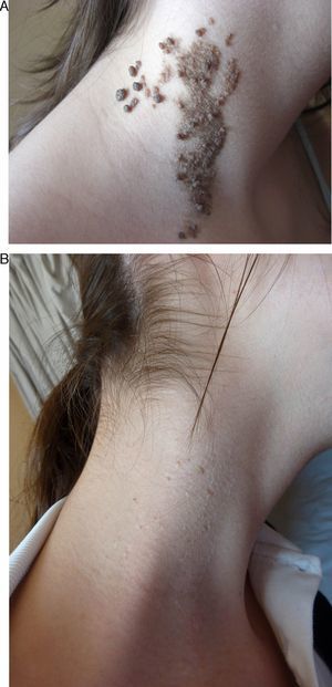 Epidermal nevus on the neck (Patient 9), before (A) and after (B) carbon dioxide laser therapy.