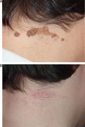 Epidermal nevus on the neck (Patient 19), before (A) and after (B) carbon dioxide laser therapy.