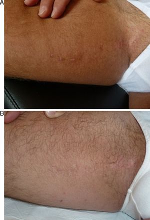Inflammatory linear verrucous epidermal nevus on the right thigh (Patient 8), before (A) and after (B) carbon dioxide laser therapy.