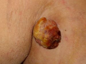Exophytic tumor on the left axilla.
