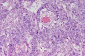 Small tumor cells of basaloid appearance. Hematoxylin-eosin, original magnification x40.