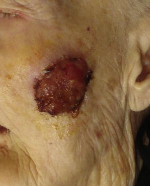 Ulcerated exophytic tumor on the left cheek.