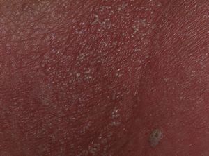 Clinical image of the nonfollicular pustules on erythematous skin on the back.