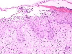 Subcorneal pustule with edema of the papillary dermis and a neutrophil-rich inflammatory infiltrate. (Hematoxylin-eosin, original magnification ×10).