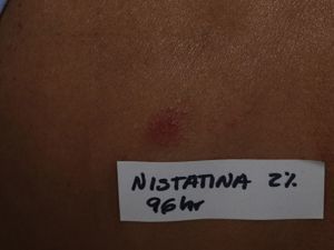 Positive patch test to nystatin, 2%, in petroleum jelly at 96h.