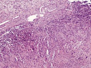 Vulvar mucosal stroma presenting a granulomatous reaction formed of palisaded epithelioid histiocytes and areas of central necrosis. Hematoxylin-eosin, original magnification ×10.