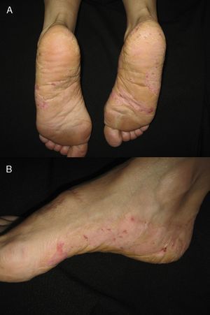 A, Appearance of the eczema on the soles of the feet. B, Lateral view.