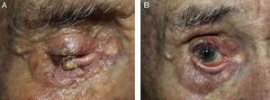 A, Clinical image before treatment, showing the presence of a tumor on the free border of the lower right eyelid. B, Final result at 6 months, after 2 sessions of photodynamic therapy and curettage of the residual lesion.