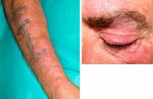 (A) Multiple painful erythematous nodules on the right forearm. (B) Multiple painful erythematous nodules in the left periorbital region.