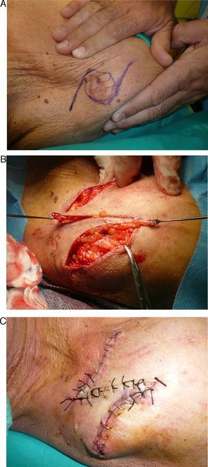 Traditional Z-plasty designed to change the orientation of a scar that was crossing the shoulder. A, Assessment of the direction of the skin tension lines. B, Transposed skin flaps. C, Notice the change in the orientation of the central limb of the Z.