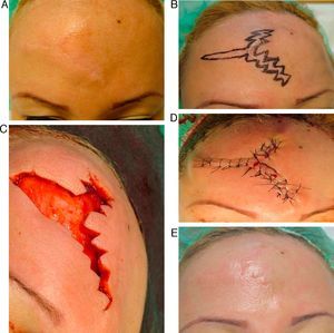 Elevated scar on the forehead corrected using a W-plasty.