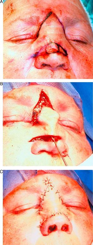 V-Y advancement flap for the reconstruction of a defect on the dorsum of the nose.