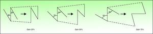 Z-plasties: length gained and change of orientation of the central limb for 3 variations with different angles.