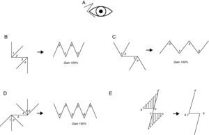 Z-plasty variants. A, Z-plasty with unequal angles. B, Four-flap Z-plasty with 45° angles. C, Four-flap Z-plasty with 60° angles. D, Six-flap Z-plasty. E, Planimetric Z-plasty.