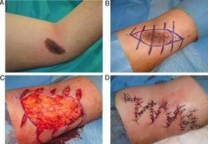 Multiple Z-plasty for the excision of a congenital nevus in the antecubital fossa.