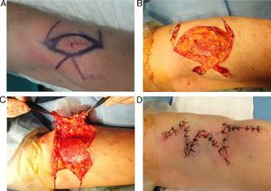 Double opposing Z-plasty to correct a scar that limited elbow flexion.