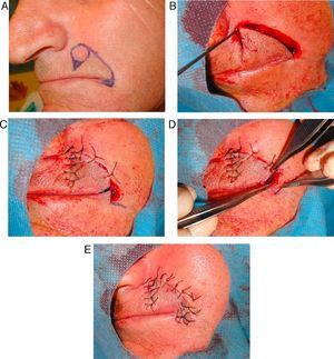 Z-plasty designed to prevent elevation of the commissure of the lips.