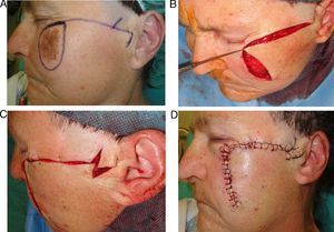 Z-plasty indicated to facilitate movement of an advancement-rotation flap for a large defect of the cheek.