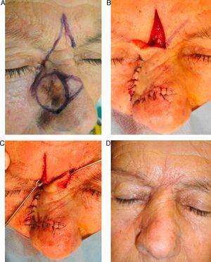 Glabellar flap combined with a Z-plasty to preserve the interciliary space.