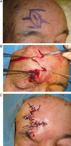 Multiple Z-plasty to camouflage a large linear scar that crossed the lines of expression on the forehead.