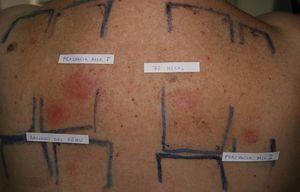 The introduction of new markers of fragrance allergy has enabled us to detect new cases and to improve the diagnosis of previously sensitized patients.