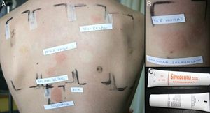 Patient with positive test results for fragrance mix I and balsam of Peru. In this case, the results were false-positive, since the patient was sensitized to sorbitan sesquioleate in a topical treatment. This substance is added as an emulsifier to some fragrance mix I and balsam of Peru patches.