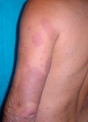 Worsening of previous lesions and appearance of multiple erythematous violaceous nodules (type 2 leprosy reaction/erythema nodosum leprosum).