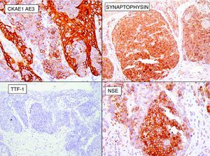 Immunohistochemistry study of the first case, showing positive staining for pancytokeratin, synaptophysin, and neuron-specific enolase, and negative staining for thyroid transcription factor 1.