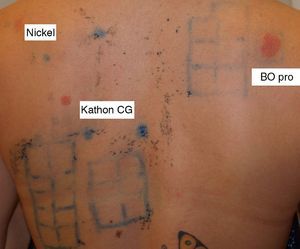 Positive patch test to nickel sulfate, Kathon CG, and the product itself at 96h.