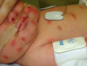 Vesiculopustular lesions predominantly on the face and, to a lesser extent, the torso.