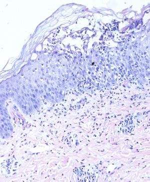 Histology image (hematoxylin-eosin, original magnification, ×40) of a subcorneal pustule filled with polymorphonuclear leukocytes showing epidermal exocytosis.