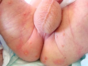 Pustules on the buttocks and thighs. The ruptured lesions appear as pigmented macules.