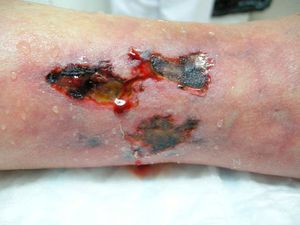 Necrotic ulcers on the legs on areas of skin with a livedoid appearance.