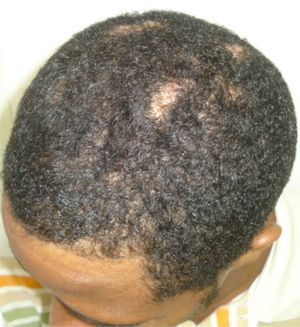 Alopecic patches with discrete nodules of DCS, resembling AA.
