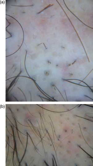 (a) Dermoscopy showing yellow dots, empty follicular openings, black dots and cadaverized hairs, very similar to AA. Exclamation mark hairs were absent (dermoscopy, at 40× magnification). (b) Dermoscopy of follow-up, showing short regrowing hairs and dystrophic hairs (dermoscopy, at 70× magnification).