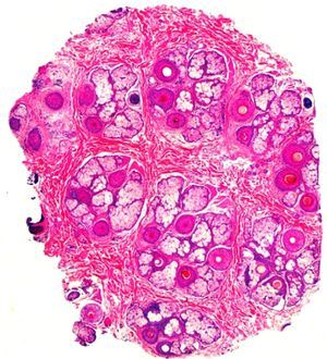 Histopathology at the infundibular level showing preserved follicular density, increased number of follicles in catagen/telogen phase, pigment casts and some follicles showing dilated empty infundibular ostia filled with sebum and keratin (Hematoxilin & Eosin, 40×).