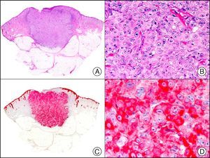 Squamous cell carcinoma. A, Low-power magnification (×10). B, Detail of neoplastic cells, showing vesicular nuclei with prominent nucleoli and abundant eosinophilic cytoplasm (×400). C, The same sample studied immunohistochemically with the pan cytokeratin antibody AE1/AE3. Note the positive staining of the neoplastic cells, the epithelium of the epidermis, and the dermal appendages (×10). D, High-power magnification of neoplastic cells stained with AE1/AE3 (×400).