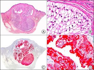 Apocrine (clear-cell) hidradenoma. A, Low-power magnification (×10). B, High-power magnification of a cluster of neoplastic cells with clear-cell morphology (×400). C, The same sample studied immunohistochemically with cytokeratin (CK) 8 (×10). D, Detail of CK8–positive neoplastic cells (×400).