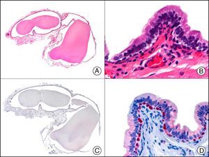 Cyst on the foreskin of a newborn. A, Low-power magnification (×10). B, Detail of epithelium of cyst wall, showing a peripheral layer of cuboidal cells and a luminal layer of columnar cells (×400). C, The same sample studied immunohistochemically with p63 (×10). D, High-power magnification showing positive reaction in the nuclei of the peripheral cells, which are probably myoepithelial cells (×400).